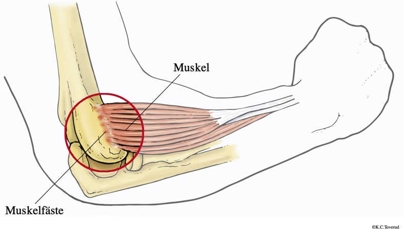 Smärtande område vid padelarmbåge